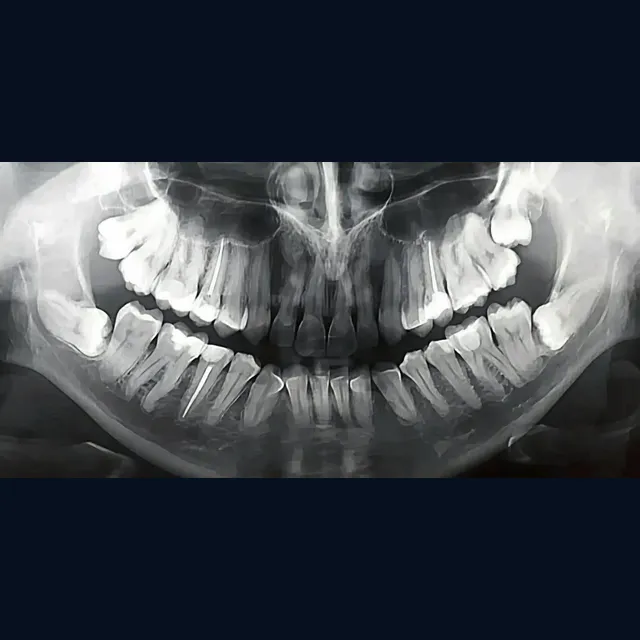 Radiografia panorâmica para cirurgia dos sisos