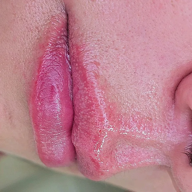 Lábios após preenchimento labial
