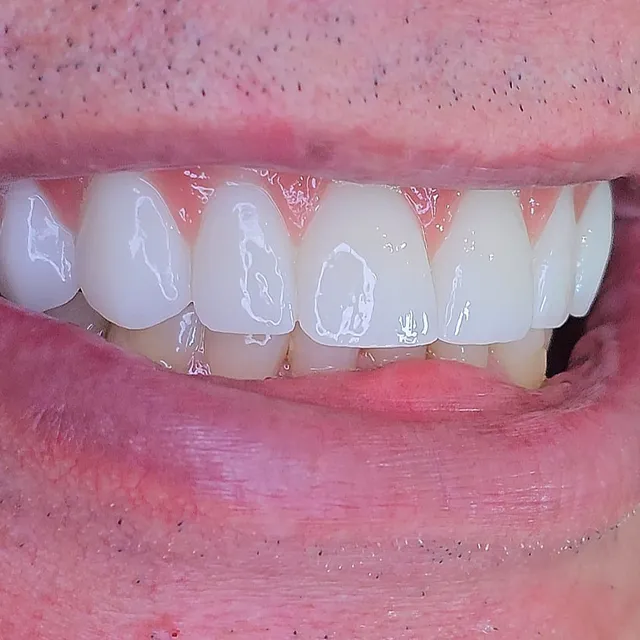 Sorriso com protocolo em zircônia