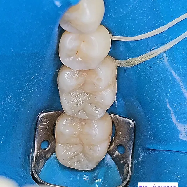 Restaurações em resina composta nos dentes posteriores